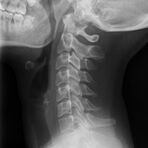 Röntgenaufnahme Halswirbelsäule